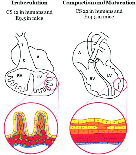 lv trabeculation and false cord|pathophysiology of trabeculation.